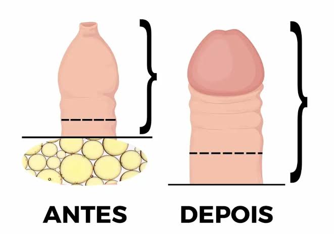 Harmonização Peniana: o que é, como funciona e por que tem sido tão procurada?